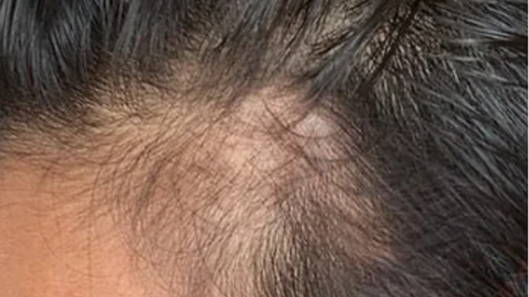 EMS HEAD SPA PRO-before